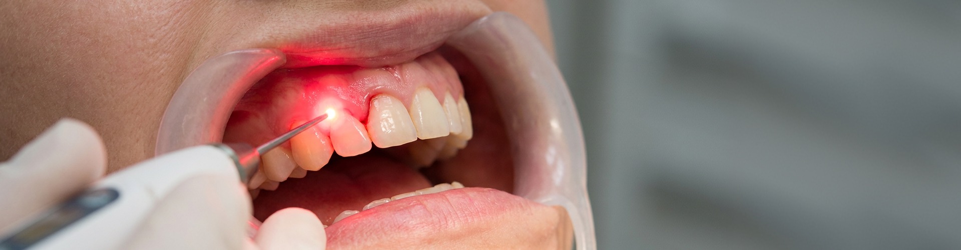 Dentist using a dental laser to treat receding gums around an upper front tooth.